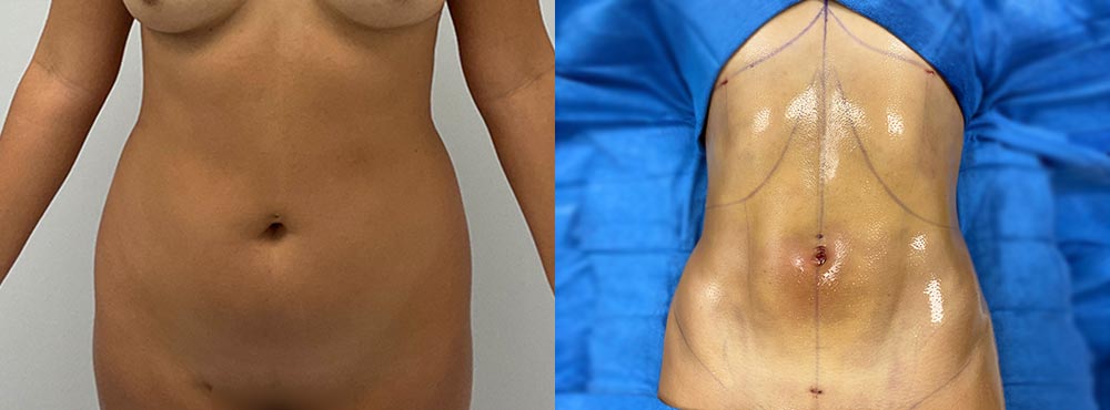 Female Abdominal Etching Miami