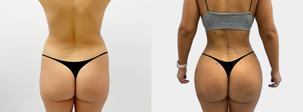 Brazilian Butt Lift Before and After