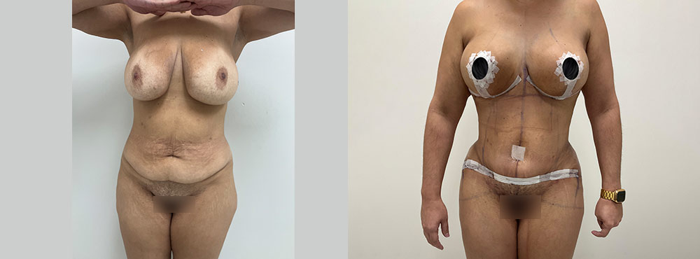 Mommy Makeover Before and After