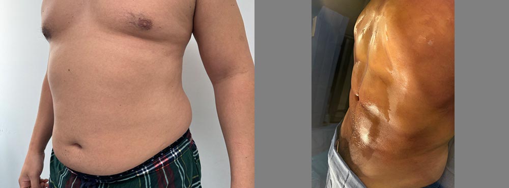 male abdominal etching before and after