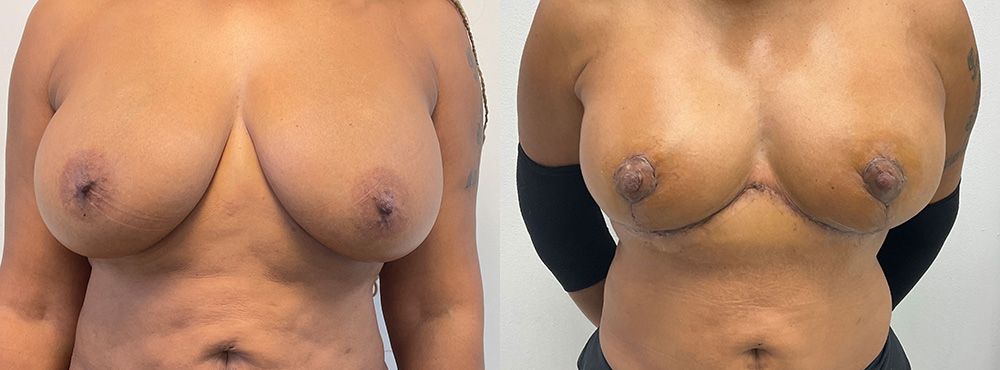 Breast Lift Before and After