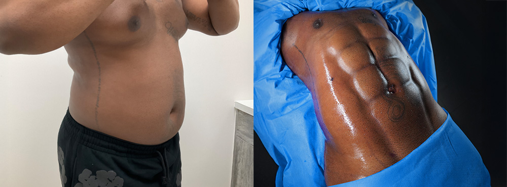 ab etching before and after in miami