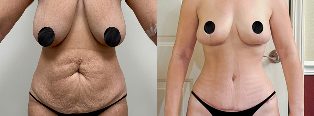 Mommy Makeover Before and After