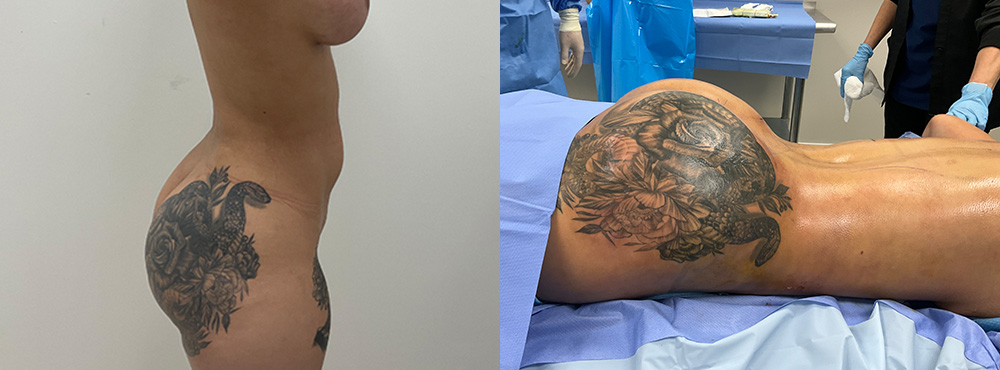Brazilian Butt Lift before and after