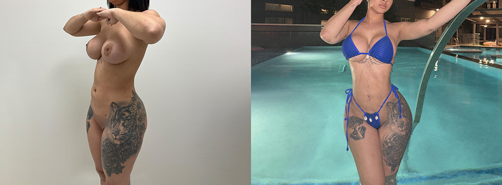 Brazilian Butt Lift before and after