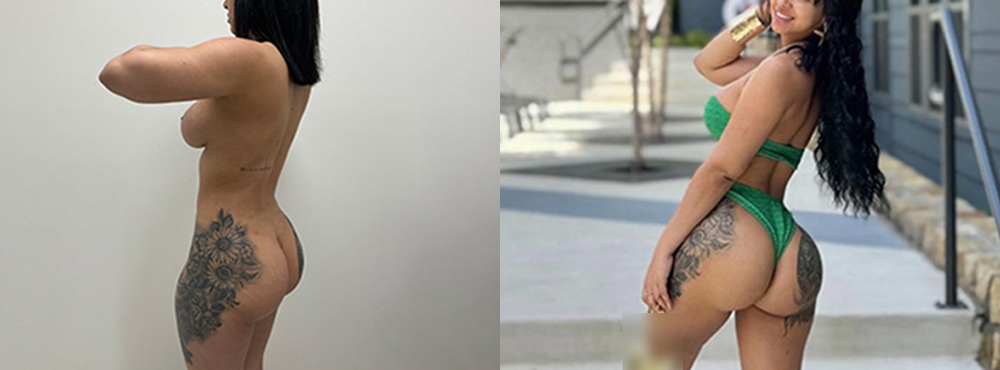 Brazilian Butt Lift before and after