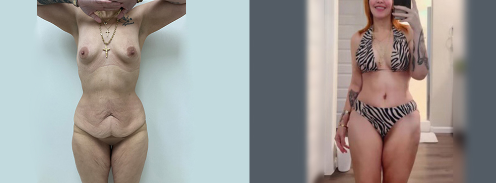 Mommy Makeover Before and After