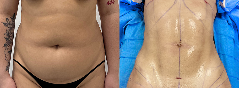 Abdominal Etching Before and After in Miami
