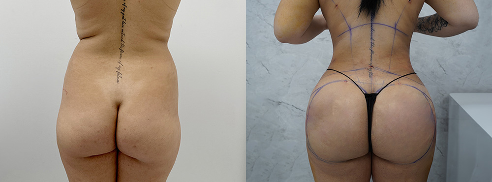 Brazilian Butt Lift Before and After in Miami