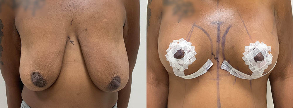 Breast Lift Before and After