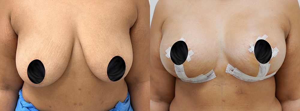 Breast Lift before and after in miami
