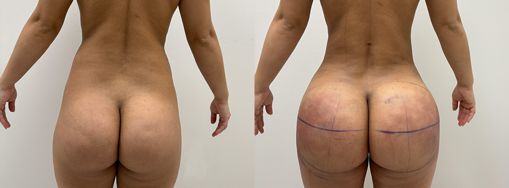 Brazilian Butt Lift Before and After in miami