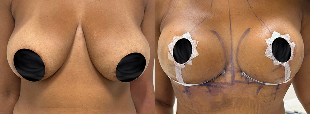 Breast Lift Before and After in Miami