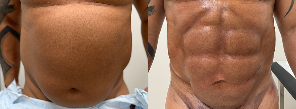 Male Abdominal Etching Before and after in miami