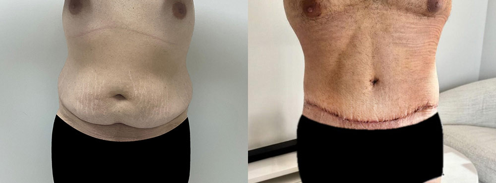 Tummy Tuck Before and After
