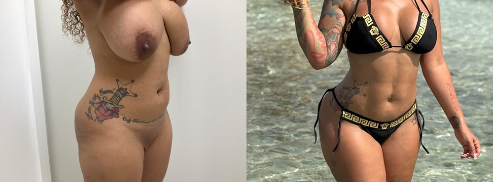 Liposuction Before and After