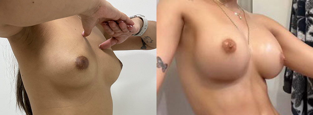 Breast Augmentation Before and After