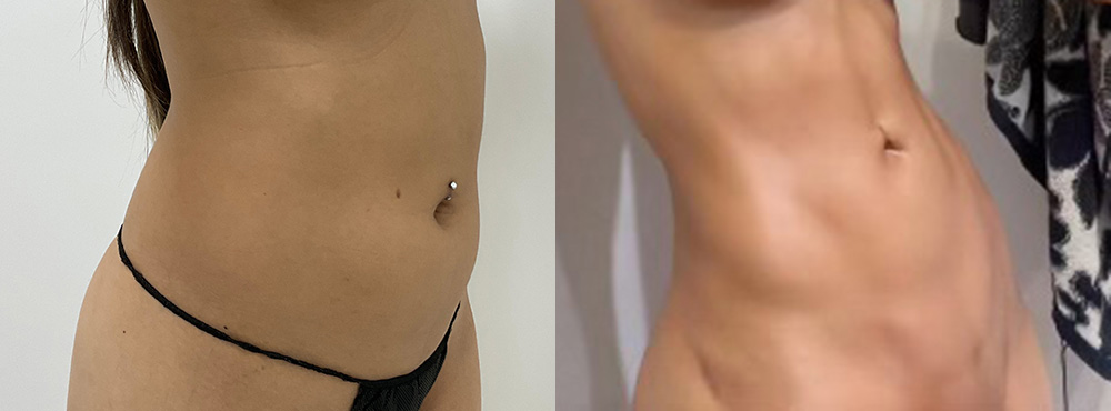 Lipo 360 Before and After