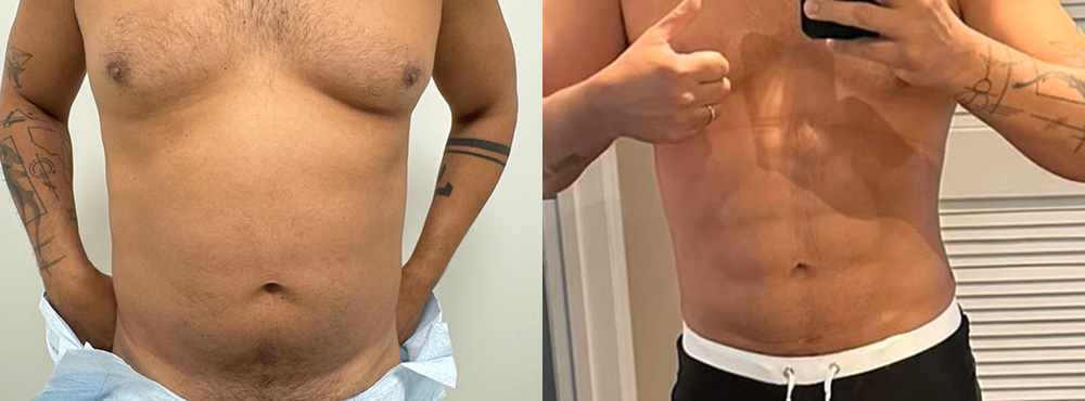 Abdominal Etching Before and After