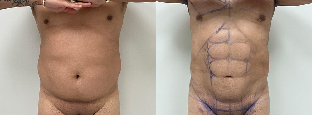Abdominal Etching Before and After