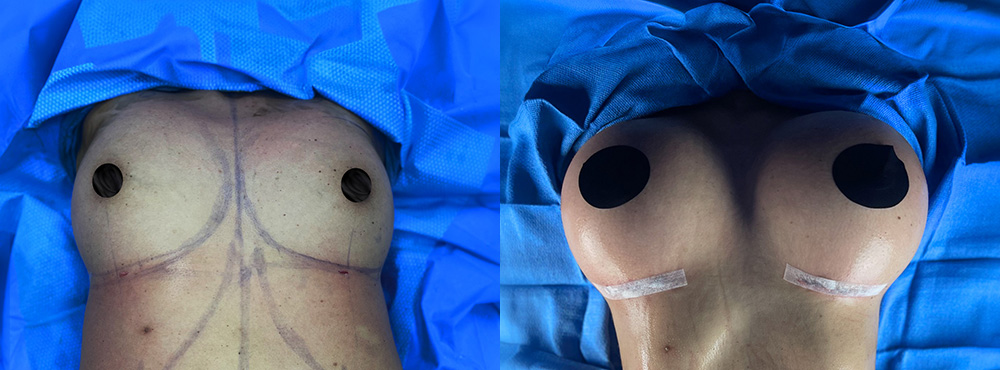 Breast Augmentation Before and After
