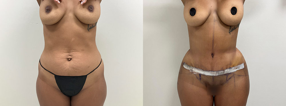 Tummy Tuck Before and After