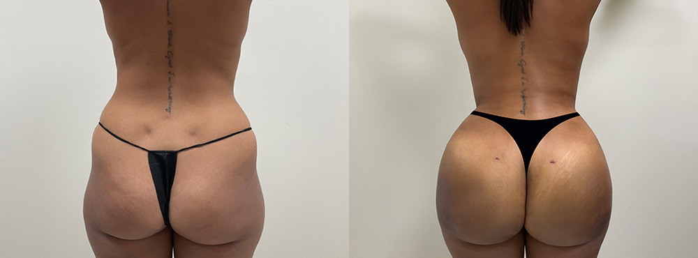 Brazilian Butt Lift Before and After