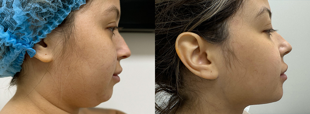 Chin Liposuction Before and After