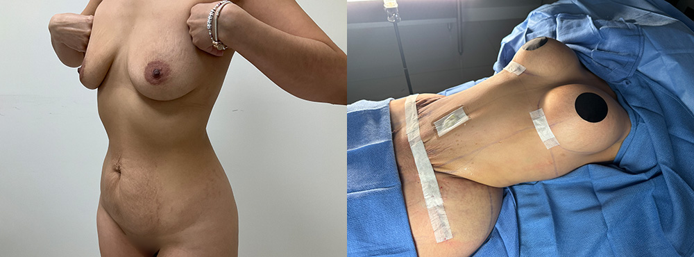 Mommy Makeover Before and After