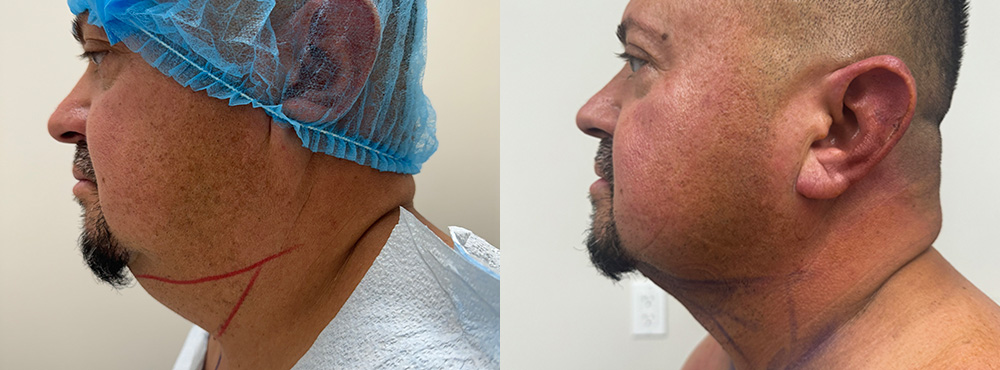Chin Lipo Before and After 