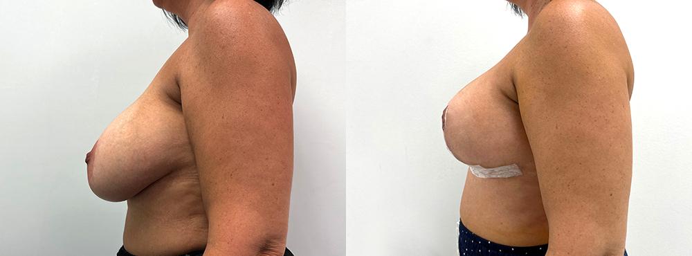 Breast Lift Before and After