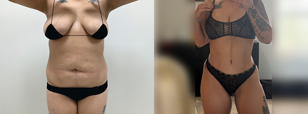 Mommy Makeover Before and After