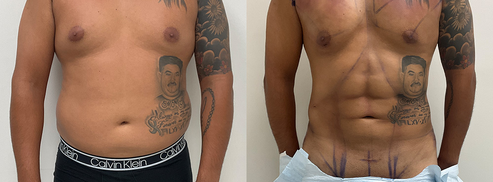 Abdominal Etching Before and After