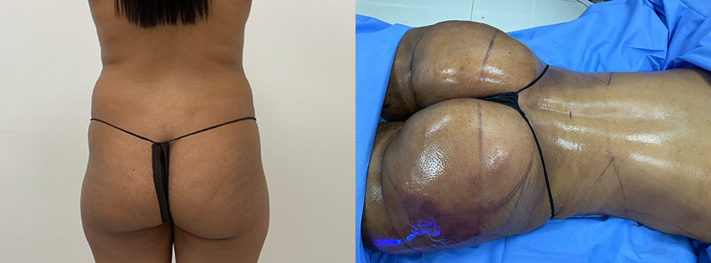 Mommy Makeover Before and After