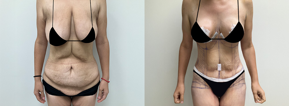 Mommy Makeover Before and After