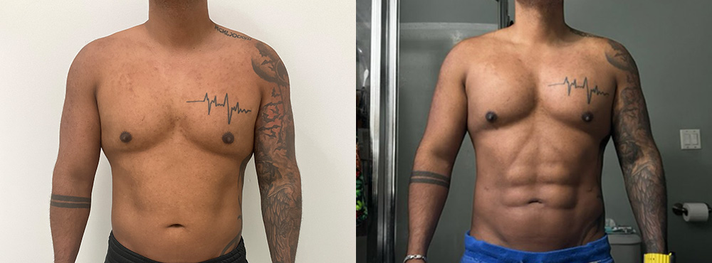 Abdominal Etching Before and After