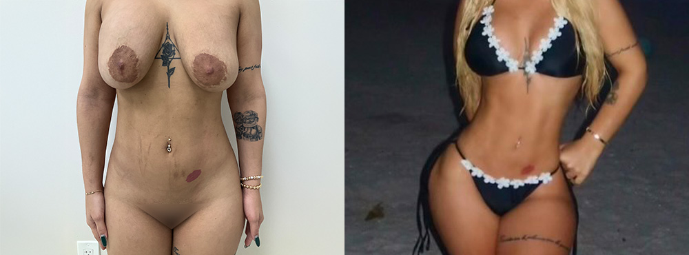 Lipo 360 before and after