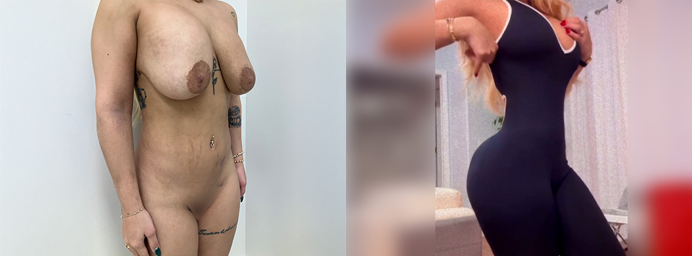 Lipo 360 before and after