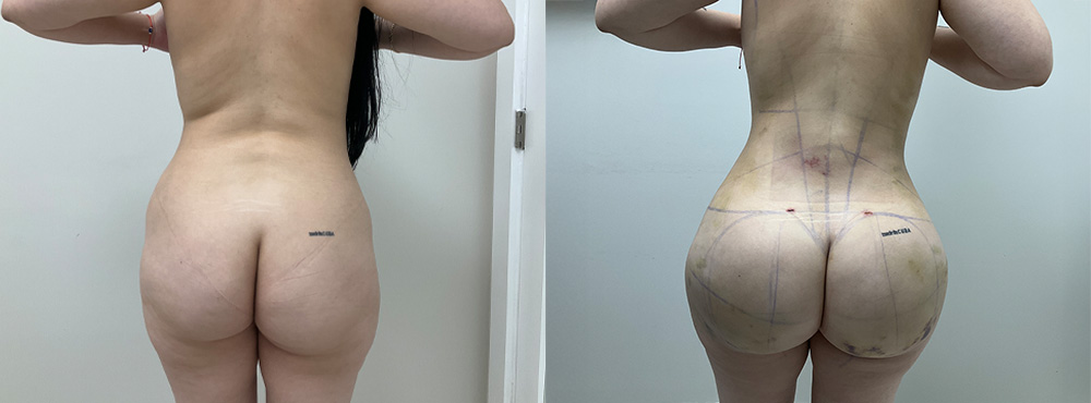 BBL before and after