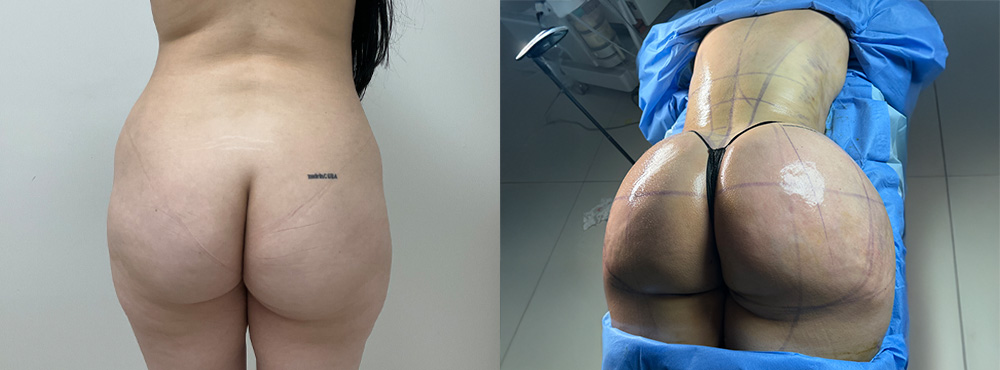 BBL before and after