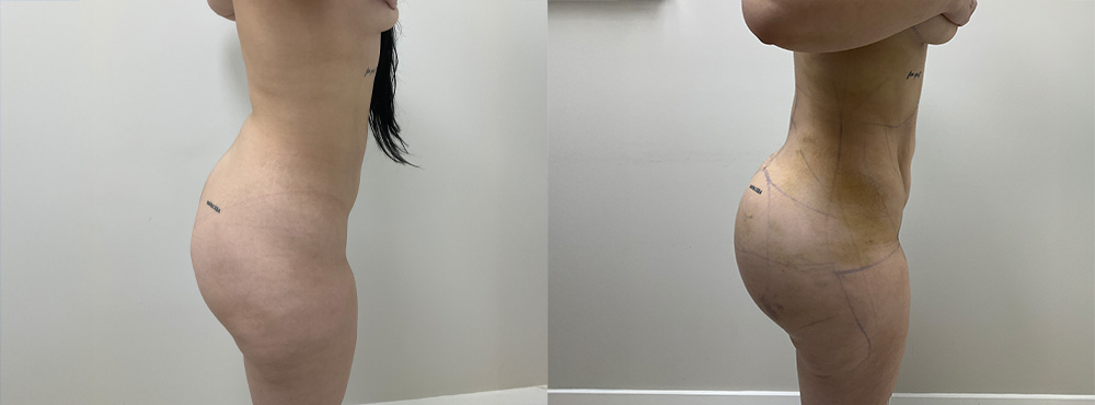 BBL before and after