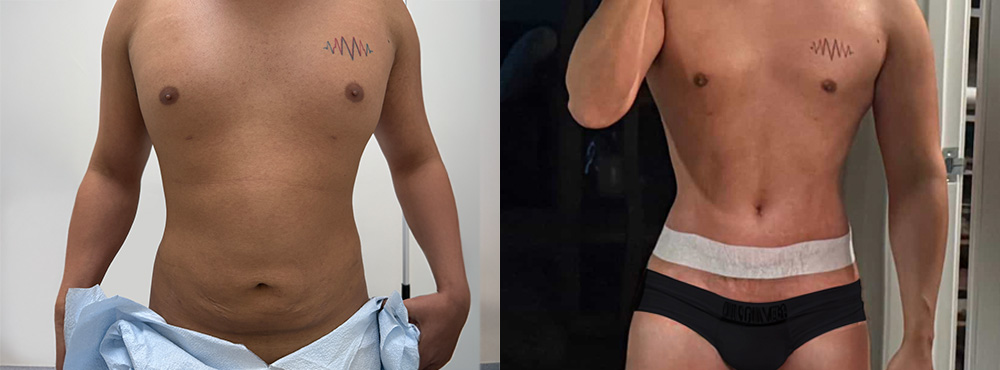 tummy tuck before and after