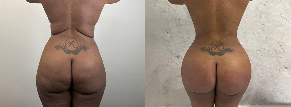 BBL Before and After