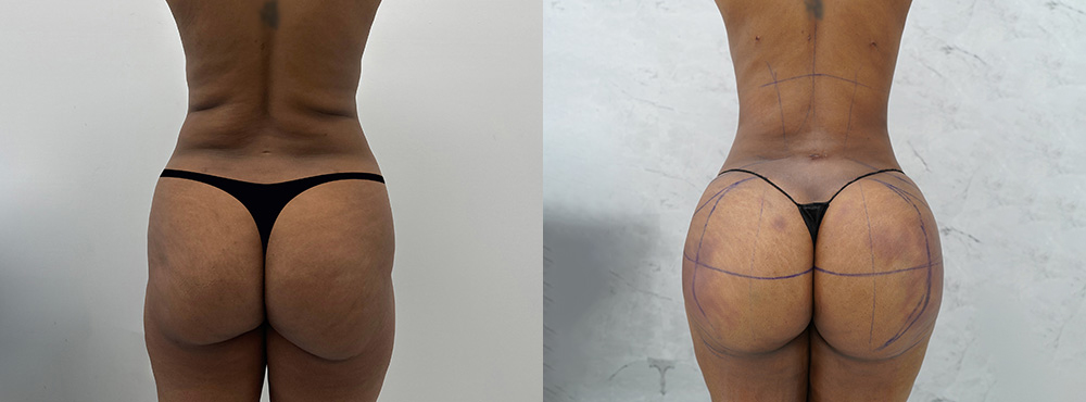 Brazilian Butt Lift Before and After in Miami