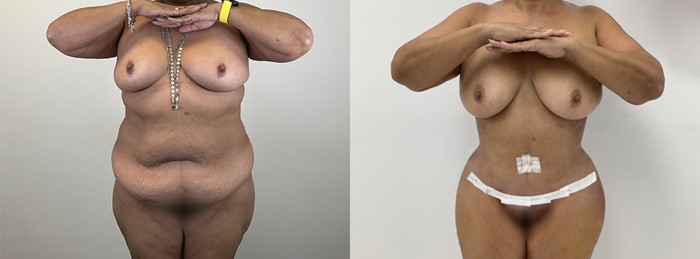 Tummy Tuck Before and After
