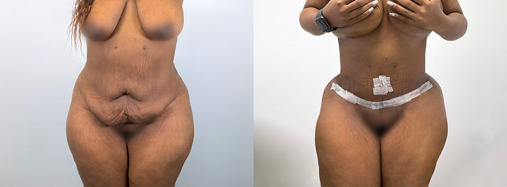 Tummy Tuck Before and After