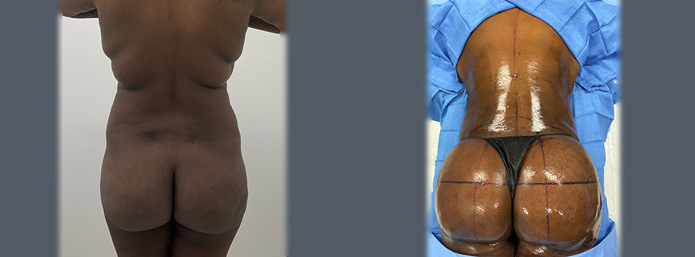 BBL Before and After in Miami