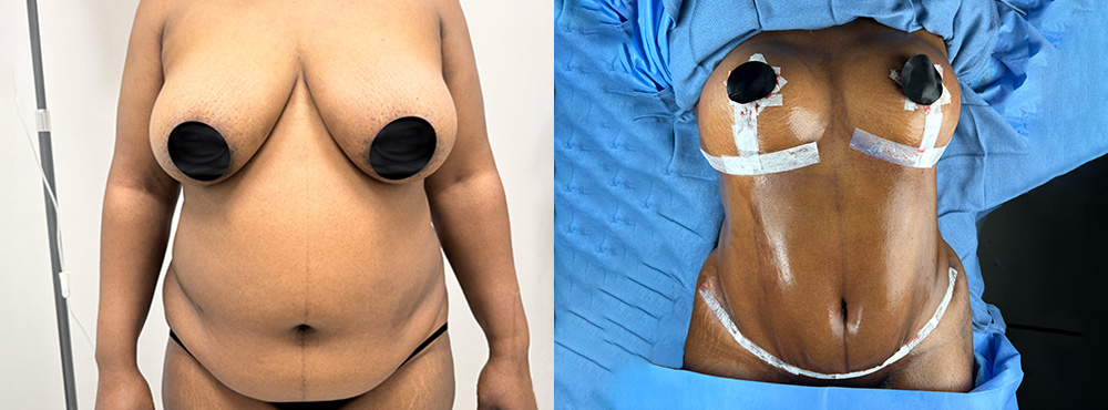 Mommy Makeover Before and After