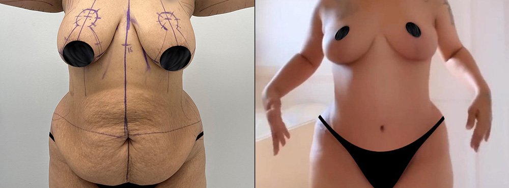 Mommy Makeover Before and After in Miami