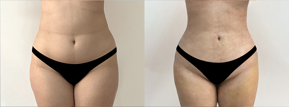 BBL  Before and After